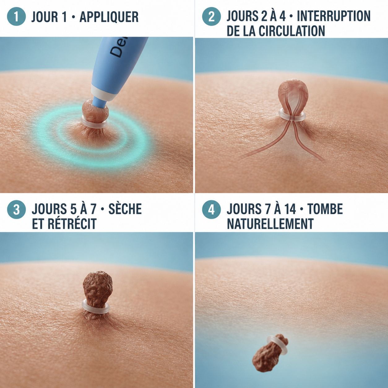 Derméa™ — Kit Anti-Acrochordons Sans Douleur