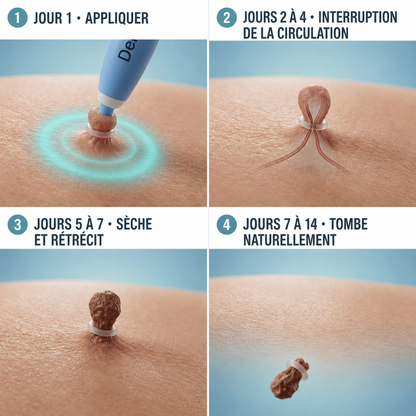 Derméa™ — Kit Anti-Acrochordons Sans Douleur